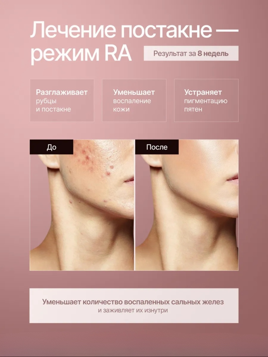 Фотоэпилятор с охлаждающей насадкой LARKO Pro Laser Hair Remover — фото 6